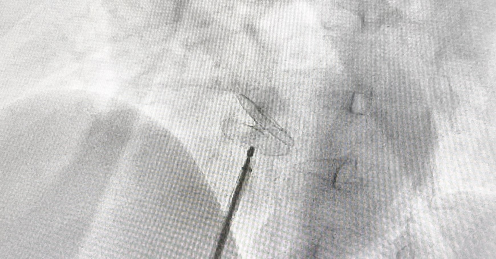 结构性心脏病介入治疗