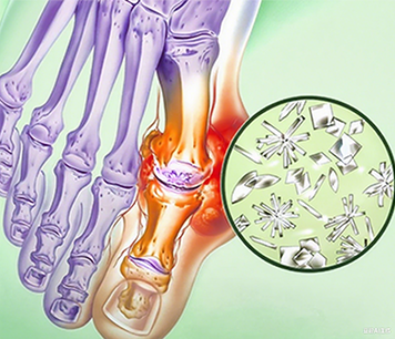 高尿酸血症诊疗