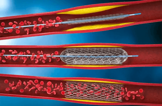 外周动静脉疾病介入治疗