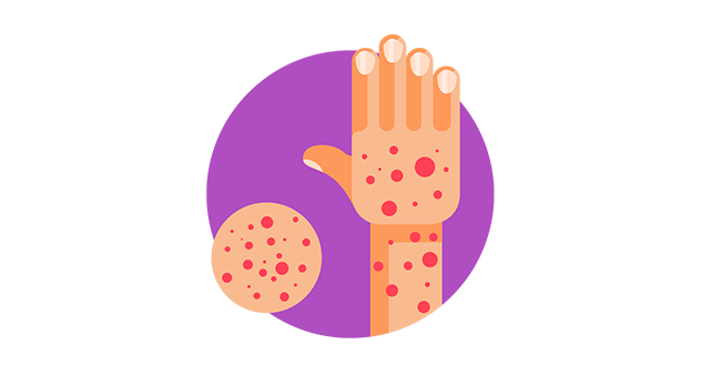 湿疹是怎么引起的？